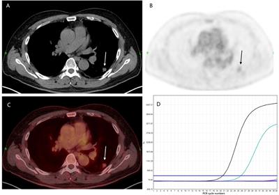 Recent and current advances in PET/CT imaging in the field of predicting epidermal growth factor receptor mutations in non-small cell lung cancer